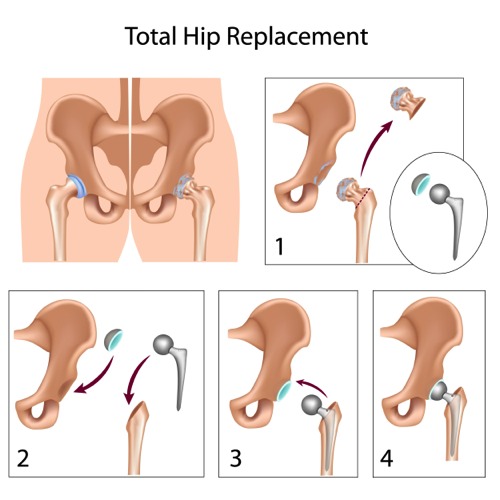 Complete Recovery Guide for Hip Replacement Surgery - Sancheti Hospital
