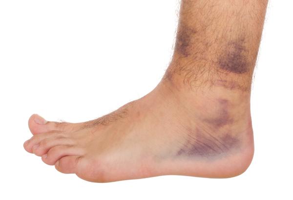 Optimizing Ankle Sprain Recovery for Athletes: ankle sprain